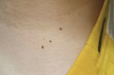 DRVIALY扁平疣專用尖銳濕疣去疣體瘊子特藥膏絲狀疣型瘊靈去除脖子小肉粒 3盒裝【頑固疣體-100%特效果】 曬單實(shí)拍圖