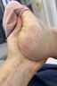 角化型腳氣頑固性腳后跟真菌感染干裂脫皮專用藥腳起硬皮足跟開裂脫皮去真菌皮膚干裂腳趾縫潰爛爛腳丫華佗膏 1盒【腳干燥開裂脫皮】推薦多盒劃算 曬單實(shí)拍圖