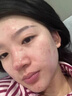 OHBT壬二酸凈膚凝膠30g控油改善痘痘痘肌消除臉上坑洼印子 曬單實(shí)拍圖