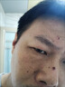 維A酸乳膏去疣體特新效期藥扁平疣專用藥去疣類藥膏去脖子小肉粒頸部瘊子去尤瘊小肉粒去疣膏瘊子肉刺肉粒 1盒裝【國藥準(zhǔn)字脫疣瘊】 瘊子去除國藥準(zhǔn)字藥膏  放心購買 安心售后 曬單實拍圖