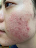 復方珍珠暗瘡片改善毛孔粗大去看黑頭醫用祛的痘消炎痤瘡硬疙瘩專(zhuān)用藥痘痘粉刺痘印治療粉刺膿包（視覺(jué)特效） 1盒裝【國藥正品保障】 曬單實(shí)拍圖