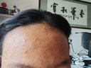 OHBT青少年祛痘膏50g學(xué)生青春痘壬二酸凝膠淡化痘印閉口粉刺縮毛孔 曬單實(shí)拍圖