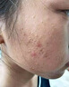 阿達(dá)帕林凝膠醫(yī)用袪痘消炎痤瘡專用青少年 痘痘藥膏治療座瘡臉上長(zhǎng)痘痘的藥 痤瘡膏 膿皰瘡小顆粒皮膚用藥 1盒 曬單實(shí)拍圖