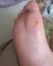 達(dá)克寧腳氣藥止癢脫皮爛腳丫真菌感染治腳氣達(dá)克寧硝酸咪康唑乳膏腳臭腳氣藥止癢真菌感染皮膚用藥 非處方藥 2盒【硝酸咪康唑乳膏】癢的受不了 老是摳腳 達(dá)克寧腳氣藥止癢脫皮爛腳丫真菌感染治腳氣 曬單實(shí)拍圖