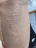 止癢抑菌皮膚瘙癢身體癢止癢濕疹特新效藥止癢去癢根皮炎濕疹真菌蕁尋麻疹根癢治藥增強免疫力維生素b6片 1盒【皮膚瘙癢止癢】%100正品 曬單實(shí)拍圖