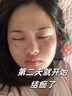 濟(jì)苑堂去痣點(diǎn)痣膏祛痣點(diǎn)疣正品專(zhuān)用無(wú)痛無(wú)痕可搭醫(yī)用藥水用藥臉部不留疤 曬單實(shí)拍圖