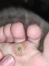 秋雅奈緒雞眼膏去i根肉刺瘊藥膏無(wú)i痛脫落連根i拔除腳底繭硬皮跖疣專(zhuān)用貼 一盒體驗裝 水楊酸軟50%去雞眼 曬單實(shí)拍圖
