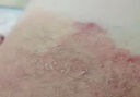 股蘚大腿內側真菌感染腹股溝股癬膏大腿根內測潮濕瘙癢癬藥水噴霧專(zhuān)用藥真菌感染皮膚用藥鹽酸特比萘芬噴霧劑 1盒【股癬大腿內側 】【視覺(jué)特效】 曬單實(shí)拍圖