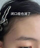 BVSYL德國高端醫用痘痘貼消炎吸膿隱形嫩膚去痘i印痤瘡痘坑痘i疤防護貼 醫用痘痘貼48貼【日夜雙效】 曬單實(shí)拍圖