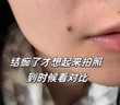 滬徑制藥去痣點痣膏祛痣膏水無痕臉部不留疤痦子瘊子面部黑痣男女士通用 曬單實拍圖