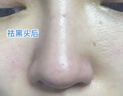 儒意（RUYI）去黑頭鼻貼免撕拉面膜黑頭導出液清理神器收縮毛孔清潔粉刺男女士 曬單實(shí)拍圖
