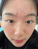 珂語祛痘膏苦參根草本植萃祛痘霜去痘痘印修護(hù)青少年青春痘面霜護(hù)膚品 【買1送1 到手2瓶裝】草本祛痘膏 曬單實(shí)拍圖