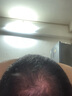 【第二代米諾地爾】蔓迪生發(fā)泡沫劑60g*2（倍速生發(fā) 溫和不起痘）防脫育發(fā)增發(fā)液5%濃度酊搽劑 曬單實拍圖