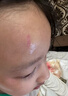 華美科醫(yī)用重組人體表皮生長因子點(diǎn)痣疤痕修復(fù)凝膠燙軟膏傷口愈合15g1支 曬單實(shí)拍圖