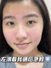 BAJK醫用天然蘆薈凝膠修復皮膚曬后軍訓保濕補水滋潤嫩膚祛痘印淡疤痕 1支裝【曬后急救/補水保濕】 曬傷修復紫外線(xiàn)過(guò)敏專(zhuān)用曬后屏障受損泛紅 曬單實(shí)拍圖