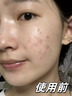 Newliann醫用械字號洗面奶狀潔面乳控油祛痘除螨蟲(chóng)去黑頭男士女士修復屏障 曬單實(shí)拍圖