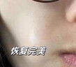 滬徑制藥去痣點痣膏祛痣膏水無痕臉部不留疤痦子瘊子面部黑痣男女士通用 曬單實拍圖