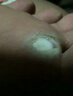 DR.SOKK雞眼貼雞眼膏去根肉刺藥膏去無(wú)痛脫落連根拔跖疣腳底趾疣去根膏貼 曬單實(shí)拍圖