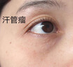 臺潤京田臺潤脂肪粒去除神器汗管廇眼部祛眼周眼角油脂粒京河華寧臺潤 療程裝3盒 曬單實(shí)拍圖