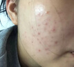 維特絲壬二酸祛痘藥膏去痘痘粉刺閉口收毛孔男女煙酰胺水楊酸青少年凝膠 曬單實(shí)拍圖