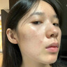 甲硝唑凝膠酒糟鼻專(zhuān)用藥治療修復紅鼻子槽玫瑰痤瘡特新效藥皮膚屏障受損草莓鼻去黑頭收縮毛孔紅鼻子紅血絲 【單盒】輕微酒糟鼻 【國藥準字】特新效期藥 曬單實(shí)拍圖