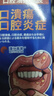 蓬仁藥業(yè)口腔潰瘍修復凝膠口腔潰瘍專(zhuān)用的藥口舌生瘡上火兒童可搭口腔潰瘍貼可搭口腔潰瘍散西瓜霜口腔潰瘍噴劑一點(diǎn)靈 曬單實(shí)拍圖