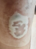 振德（ZHENDE）水膠體敷料醫用5片10*10cm促濕性傷口愈合痘痘貼人工皮敷貼 曬單實(shí)拍圖