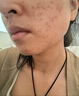 維特絲壬二酸祛痘藥膏去痘痘粉刺閉口收縮毛孔男女煙酰胺水楊酸 曬單實拍圖