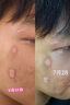 光專嘉308白癜風(fēng)治療儀準(zhǔn)分子激光紫外線光療儀家用白斑uvb銀屑病牛皮癬 308nm準(zhǔn)分子 進(jìn)口氯化氙照光機(jī)照射燈JG20 醫(yī)用醫(yī)院窄譜中波官方儀器同款 曬單實(shí)拍圖