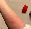 氯雷他定片皮膚瘙癢抗過敏藥蕁麻疹尋麻疹根癢治藥蕁麻疹特專用效藥斷根止癢增強免疫力真菌抑菌身體癢進口藥 1盒【皮膚瘙癢難忍】100%國藥正品 曬單實拍圖