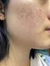 維特絲壬二酸祛痘藥膏去痘痘粉刺閉口收縮毛孔男女煙酰胺水楊酸 曬單實拍圖