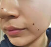 紐利安（Newliann）點痣膏去痣修復液臉部點疣藥水祛斑疤痕無痕美容院專用官方正品 曬單實拍圖