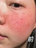 Newliann醫(yī)用重組三型人源化膠原蛋白乳液修復(fù)敷料凝膠人表皮生長(zhǎng)因子面霜 曬單實(shí)拍圖