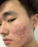 南京同仁堂祛痘膏去痘痘和痘印痘坑修復男女士改善粉刺閉口30g 曬單實拍圖