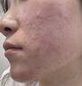 維特絲壬二酸祛痘膏煙酰胺凝膠去痘痘和痘印粉刺閉口水楊酸收毛孔青少年 曬單實(shí)拍圖