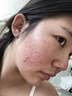 維特絲壬二酸祛痘藥膏煙酰胺凝膠去痘痘粉刺閉口男女水楊酸收毛孔青少年 曬單實(shí)拍圖