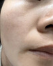 醫用精華液械字號收縮毛孔粗大修復細致去黑頭粉刺閉口男士女士祛痘印黑色素沉淀控油淡化痘印痘坑透明質(zhì)酸鈉 曬單實(shí)拍圖
