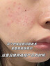 Newliann醫用祛痘印去黑色素沉淀去除膏痘痘貼和修復痘坑疤痕淡化青春痘 曬單實(shí)拍圖