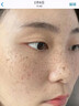 焦博士日本377祛斑霜美白淡化老年黃褐雀斑黑色素熊果苷乳膏去曬男女士 曬單實拍圖