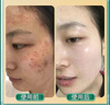 OHBT祛痘膏60g青春痘閉孔粉刺收縮毛孔專用學生男女凝膠男士化妝品 曬單實拍圖