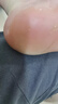 歐泉琳點(diǎn)痣筆美容院專(zhuān)用小白掃斑點(diǎn)痣專(zhuān)用筆扁平疣儀器激光點(diǎn)斑消痣神器 曬單實(shí)拍圖