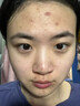 南京同仁堂祛痘膏去痘痘和痘印痘坑修復(fù)男女士改善粉刺閉口30g 曬單實拍圖