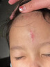 邦孚手美國進(jìn)口硅酮去祛疤痕修復(fù)凝膠醫(yī)用醫(yī)院專用去疤膏兒童手術(shù)縫針 曬單實(shí)拍圖