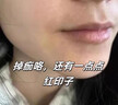 滬徑制藥去痣點痣膏祛痣膏水無痕臉部不留疤痦子瘊子面部黑痣男女士通用 曬單實拍圖