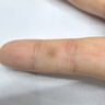 祥醫堂咪奎莫特乳膏5%醫用祛疣型京東大藥5%咪喹正品軟膏疣體脫落專(zhuān)用膏 1盒 曬單實(shí)拍圖