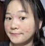 泊紫汀蘭祛痘膏祛痘淡化痘印消閉口修護痘痕痘坑去粉刺控油青春痘男女學(xué)生 曬單實(shí)拍圖