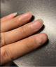 Newliann醫用甲溝炎消腫專(zhuān)用工具息肉紅腫去肉芽嵌甲發(fā)炎化膿膏矯正器制藥 曬單實(shí)拍圖
