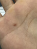 玥羲醫(yī)用液氮冷凍疣尖銳濕疣尋常疣物理疣跖疣肉粒疙瘩肉刺瘊子絲狀疣 1瓶500ml帶導(dǎo)管+棉簽【醫(yī)院同款】 曬單實(shí)拍圖