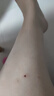 dyey點(diǎn)痣膏無(wú)痕去痣黑痣瘊子點(diǎn)痣液扁平尤絲狀尤尖尤肉刺肉兒童可用 曬單實(shí)拍圖