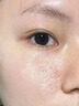 醫(yī)用精華液械字號(hào)收縮毛孔粗大修復(fù)細(xì)致去黑頭粉刺閉口男士女士祛痘印黑色素沉淀控油淡化痘印痘坑透明質(zhì)酸鈉 曬單實(shí)拍圖